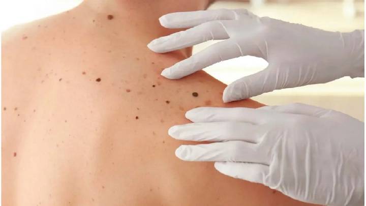 Campaña refuerza la lucha contra el cáncer de piel en Argentina