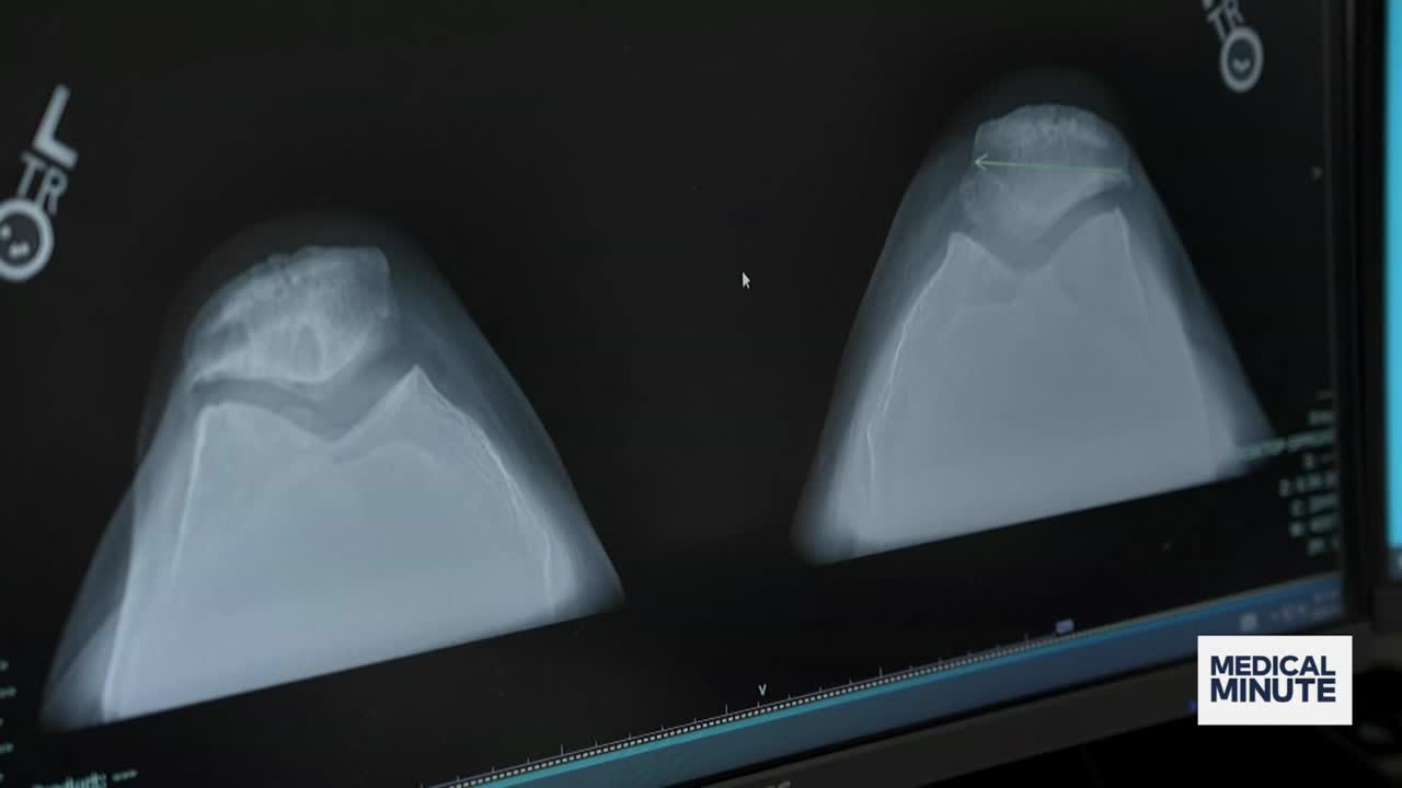 Health experts share ways to manage knee pain without surgery