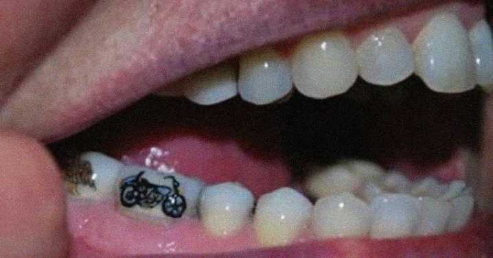 Young People Are Ditching Skin Tats for Tooth Tattoos