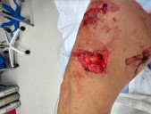 Dog mauling at OC animal shelter sparks negligence suit from volunteer