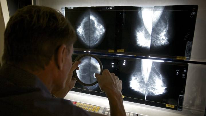New breast cancer screening trial may answer key AI question