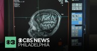New gene therapy shows great promise in fighting Huntington's disease