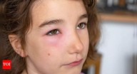 What causes puffy eyes: Symptoms, health conditions, and natural remedies