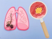 Cáncer de pulmón en no fumadores va en incremento