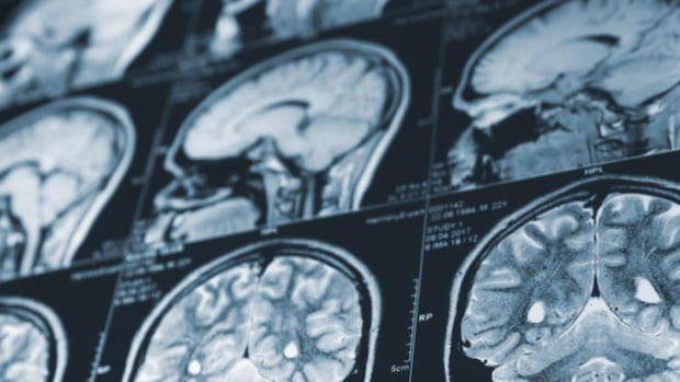 N.B. delays report on mystery brain illness, sends all data for federal review