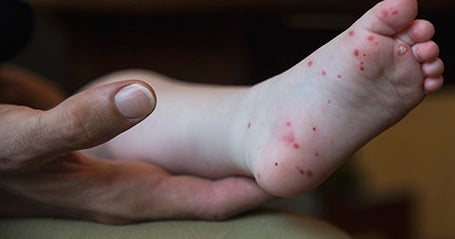 Cases of hand, foot, and mouth disease reported at Monessen elementary school
