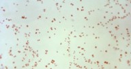 Sexually transmitted disease cases fall, but not syphilis in newborns