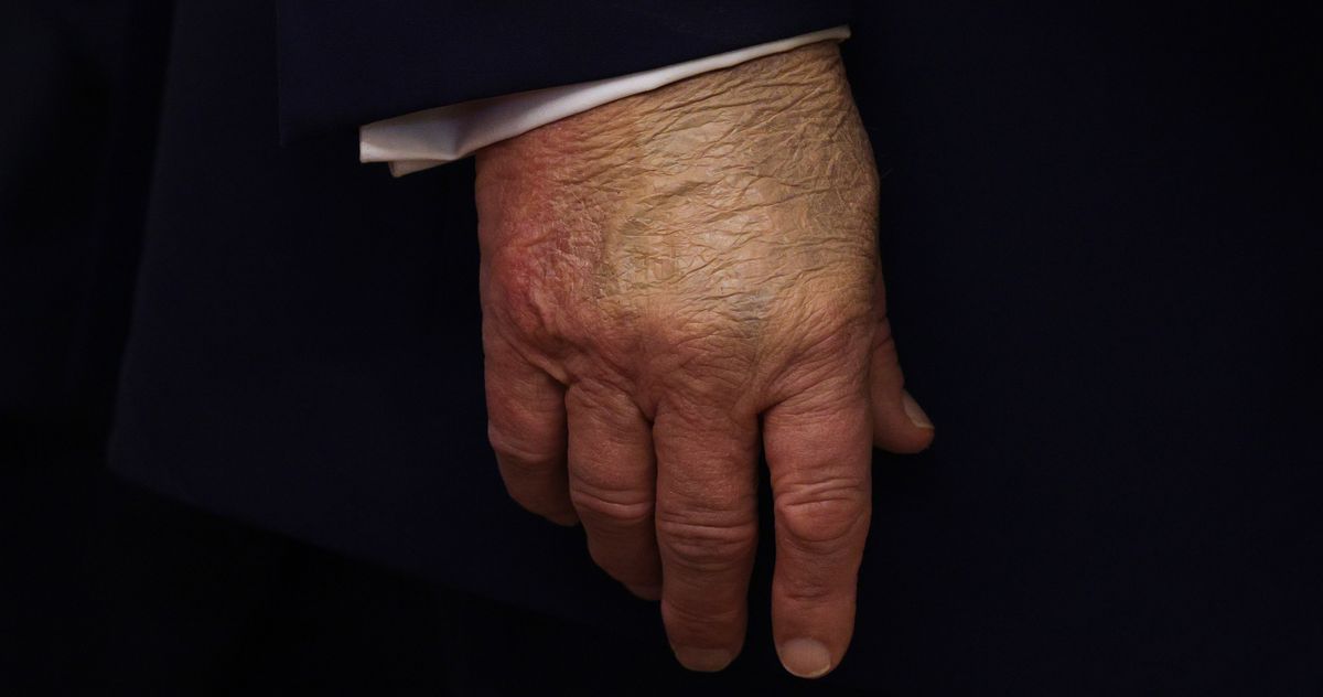 Donald Trump Is Getting Better At Covering His Bruises