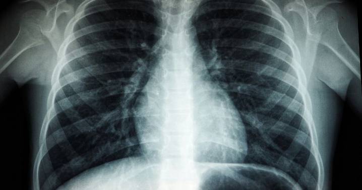 Duke study reveals new origin of deadly lung cancer, paving way for innovative treatments :: WRAL.com