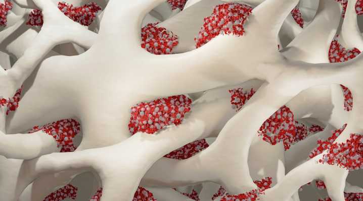 Modified Glue Gun Delivers Personalized Fracture Treatment