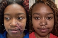 Acid Attack Survivor Gets Reconstructive Surgery. See the Before