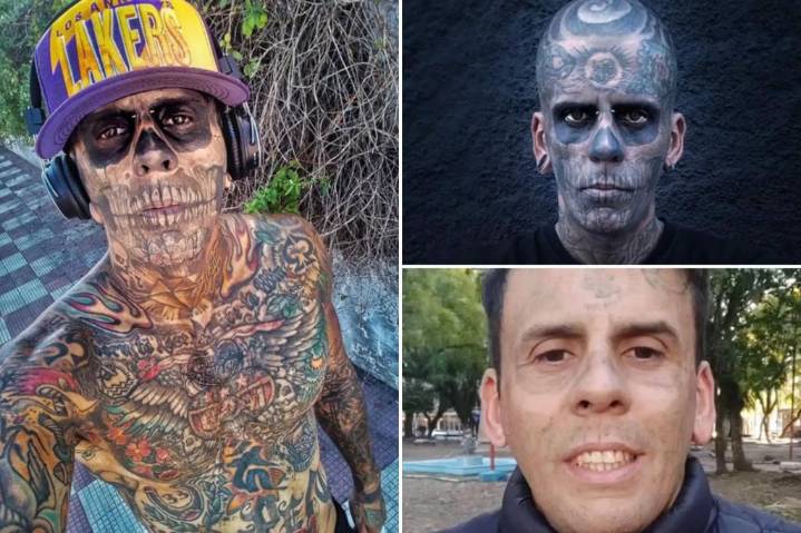 I had tattoos on 95% of my body — now I'm having them removed, and the pain is horrible