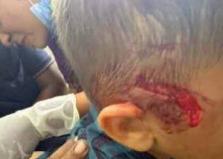 Five-year-old child attacked by pack of stray dogs in Surat district