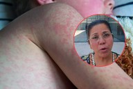 Sarampión en Campeche: Salud llama a vacunarse tras 14 contagios confirmados