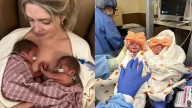 Arizona twins survive rare condition, in
