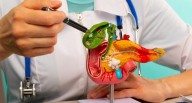 Comer para vivir: Qué son los cálculos en la vesícula y cómo evitarlos