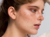 Elimina el melasma de la cara