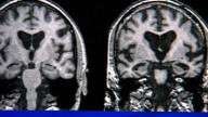 “Todo el dolor reside en el cerebro”, alternativas a los analgésicos para combatir el dolor crónico