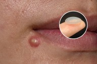 Scientists Invent Patch That Makes Pimples 'Disappear' Pain
