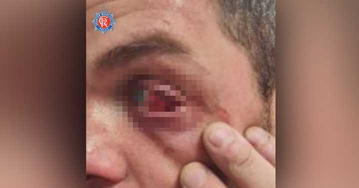 Police officer bitten and left with eye injuries after wanted man lashes out
