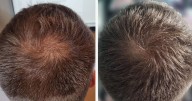 Practitioner-grade £20 hair loss tablets leave shoppers 'so impressed' with growth