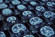 FDA Approves Leqembi Autoinjector for Maintenance Dosing in Alzheimer’s