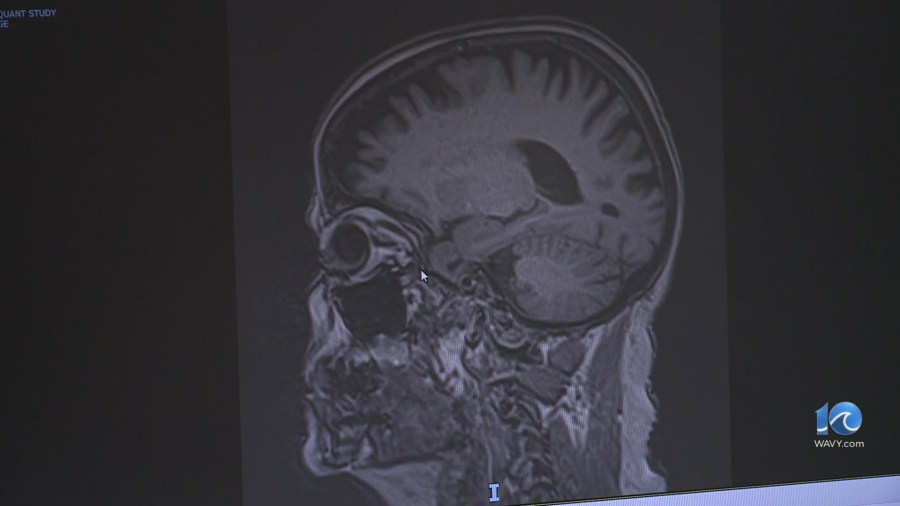 Experts: Alzheimer’s prevention drug could be close