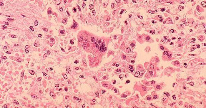 Los Angeles County child dies of rare measles complication years after infection