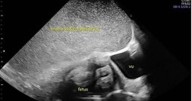 Pregnant woman complains of tummy pain before ultrasound scan unveils alarming find