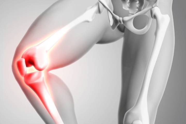 Crean cartílago artificial que detecta y bloquea el dolor de la artritis