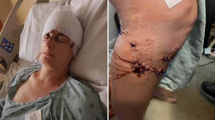 'They tried to eat me alive!' Texas mother survives brutal dog attack