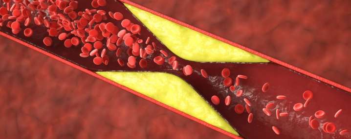 Half of Heart Attacks in Younger Women Aren't From Clogged Arteries