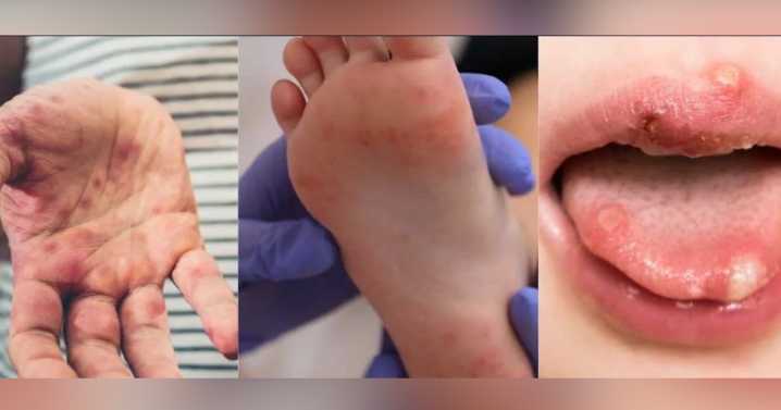Shelby County Health Department investigating hand, foot, and mouth disease outbreak in MSCS