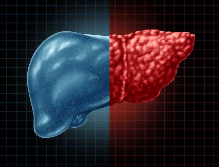 MASLD: Deadliest Risk Factors of Common Liver Disease Found