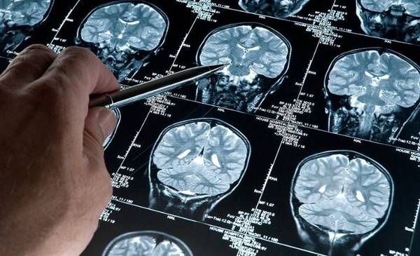 Científicos argentinos hicieron un nuevo hallazgo sobre el Alzheimer