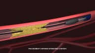 Veryan Rotational Atherectomy System