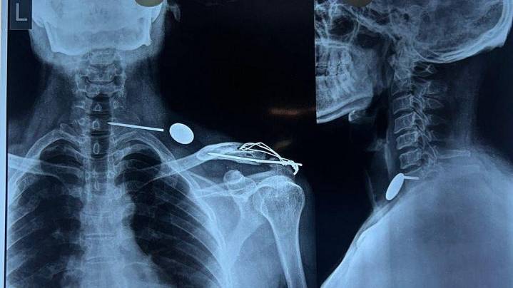 Indore News: Steel Nail Moves From Man’s Shoulder To Throat, Removed In 2.5