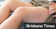 Measles cases spiking across Queensland