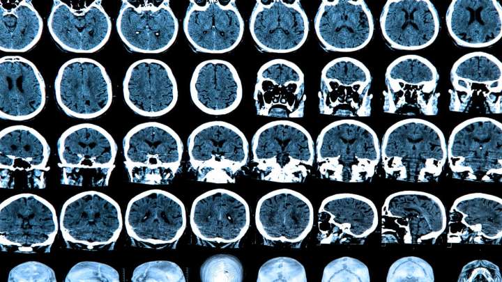 Gene Therapy Slows Huntington’s by 75% in 'Groundbreaking' Clinical Trial