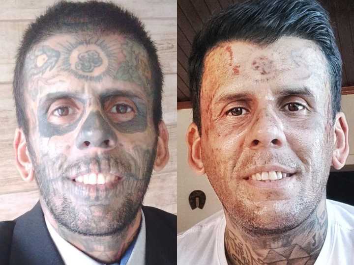 Man with tattoos on 95% of his body shares removal process