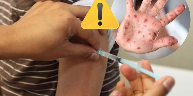 Analizan posible caso de sarampión en Arandas