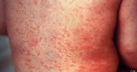 Oconto County measles cases jumps to 36