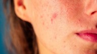 Why Internal Inflammation Shows Up On Your Skin As Acne And Rashes