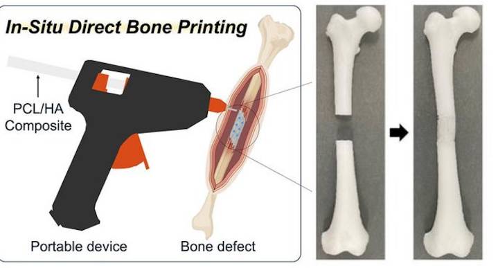 3D-Printing ‘Glue Gun’ Can Repair Bone Fractures During Surgery Filling