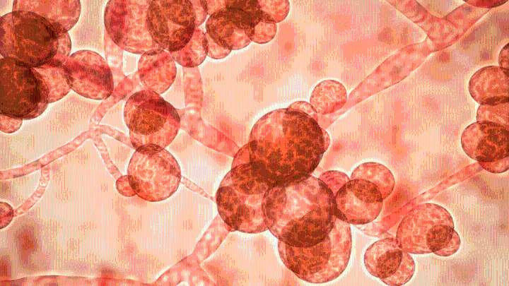 Treatment-resistant fungus cases rising in Kansas: KDHE