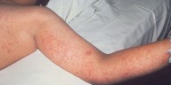 Number of measles cases in Wisconsin remains at 24 as of Friday