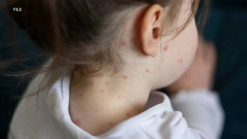 The mystery behind a rare measles-related killer, SSPE, plus 3 strategies to protect young children