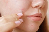 How Do Pimple Patches Work? 3 Ways They Help Blemishes Heal