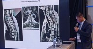 Más de 300 cirujanos compartieron en Bariloche los últimos avances en cirugía espinal