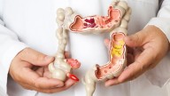 Cáncer de colon: médicos piden que la colonoscopía se haga a partir de los 45 años